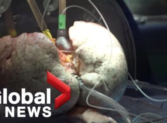 Canadian medical experiment could revolutionize organ transplants - Global News